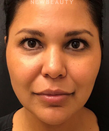 dr-janet-allenby-liquid-facelift-b