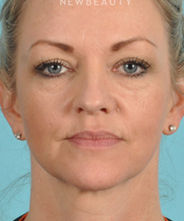 dr-bradley-bengtson-injectables-fillers-b