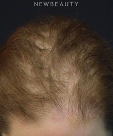 dr-jeffrey-wise-hair-loss-treatment-b