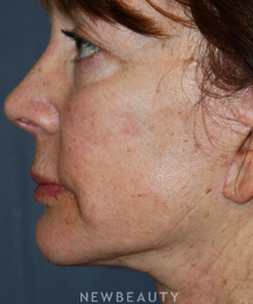 dr-brent-j-smith-facelift-with-fat-transfer-b