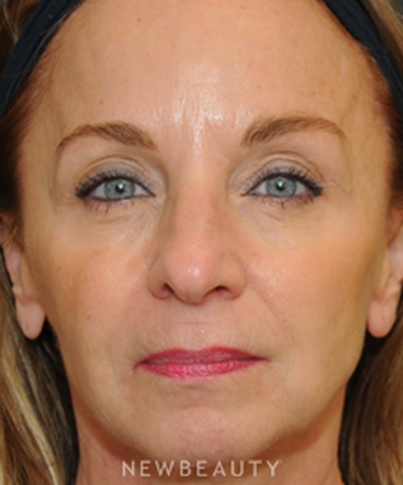 dr-janet-allenby-facial-rejuvenation-b