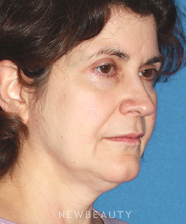 dr-konstantin-vasyukevich-traditional-facelift-b