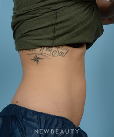 dr-jeffrey-wise-coolsculpting-b
