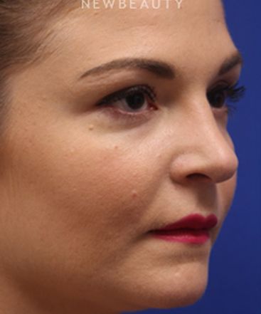 dr-jennifer-levine-rhinoplasty-b