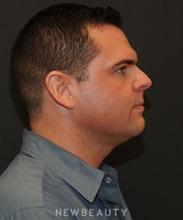 dr-janet-allenby-kybella-b