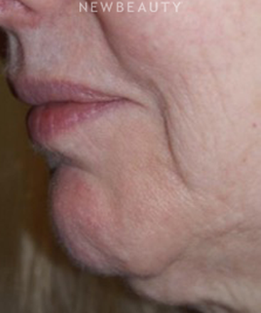 dr-marina-peredo-botox-b