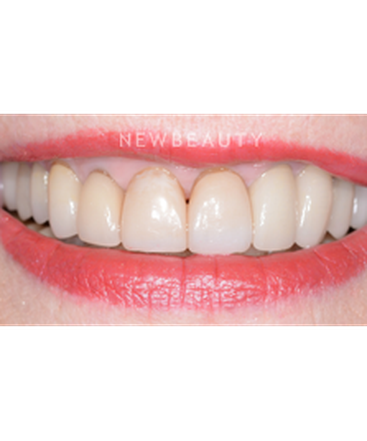 dr-guy-lewis-smile-makeover-b