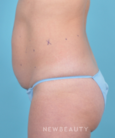 dr-bradley-bengtson-coolsculpting-b