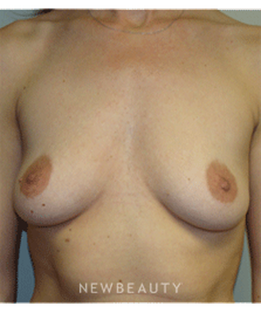 dr-sanjay-grover-breast-augmentation-b