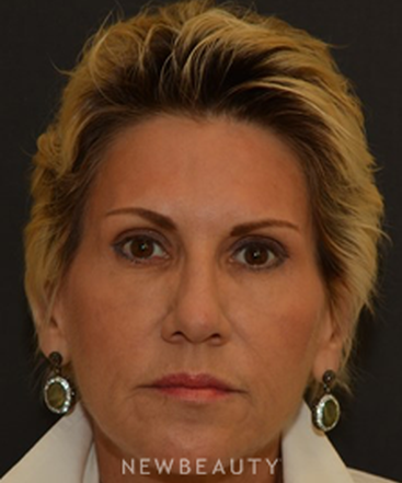 dr-janet-allenby-dysport-b