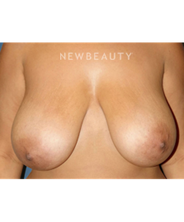 dr-bryan-gawley-breast-augmentation-b