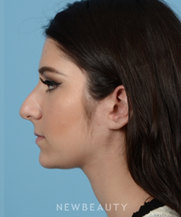 dr-jeffrey-b-wise-rhinoplasty-b