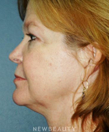 dr-brent-smith-cheekneck-mini-lift-blepharoplasty-b