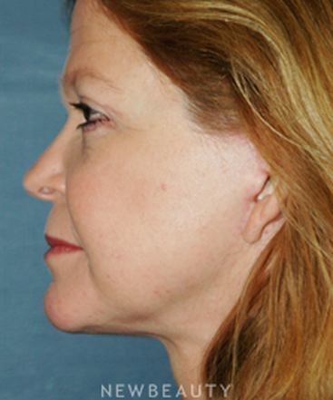 dr-brent-smith-cheekneck-mini-lift-blepharoplasty-b