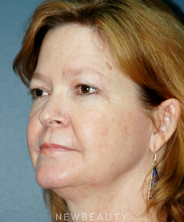 dr-brent-smith-cheekneck-mini-lift-blepharoplasty-b