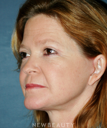 dr-brent-smith-cheekneck-mini-lift-blepharoplasty-b