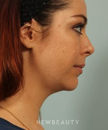 dr-kenneth-beer-kybella-b