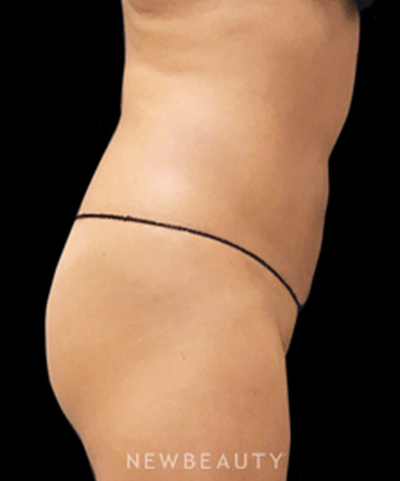 dr-janet-allenby-coolsculpting-b