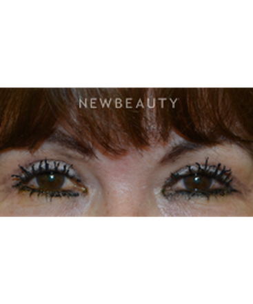 dr-baljeet-k-purewal-upper-blepharoplasty-b