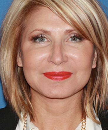 dr-konstantin-vasyukevich-traditional-facelift-b