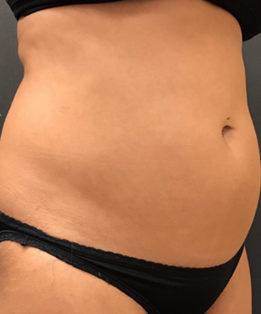 dr-janet-allenby-coolsculpting-b