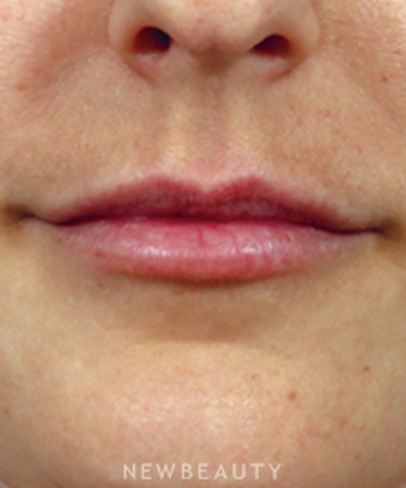 dr-kenneth-r-beer-the-art-of-lip-enhancement-b