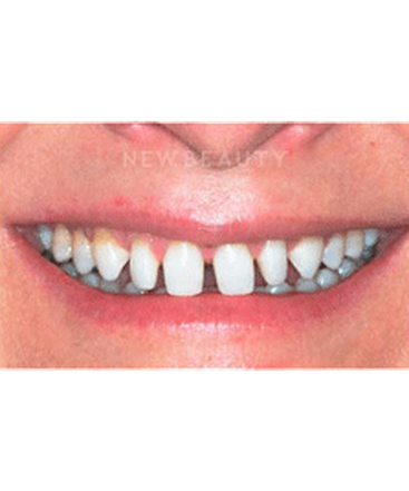 dr-guy-lewis-veneers-b