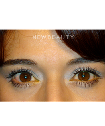 dr-baljeet-k-purewal-lower-blepharoplasty-b