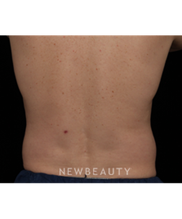 dr-jennifer-segal-coolsculpting-b