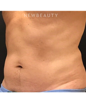 dr-janet-allenby-coolsculpting-b