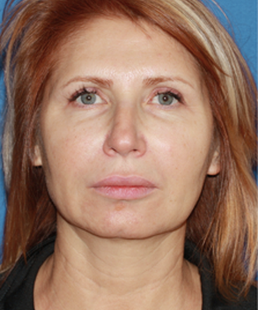 dr-konstantin-vasyukevich-traditional-facelift-b