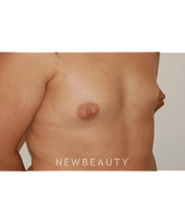 dr-david-rapaport-breast-augmentation-b