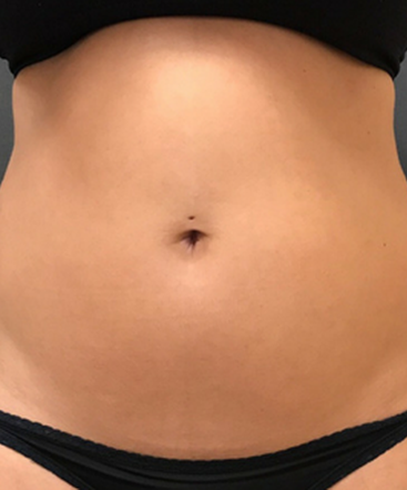 dr-janet-allenby-coolsculpting-b