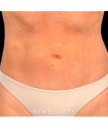 dr-bradley-bengtson-liposuction-b