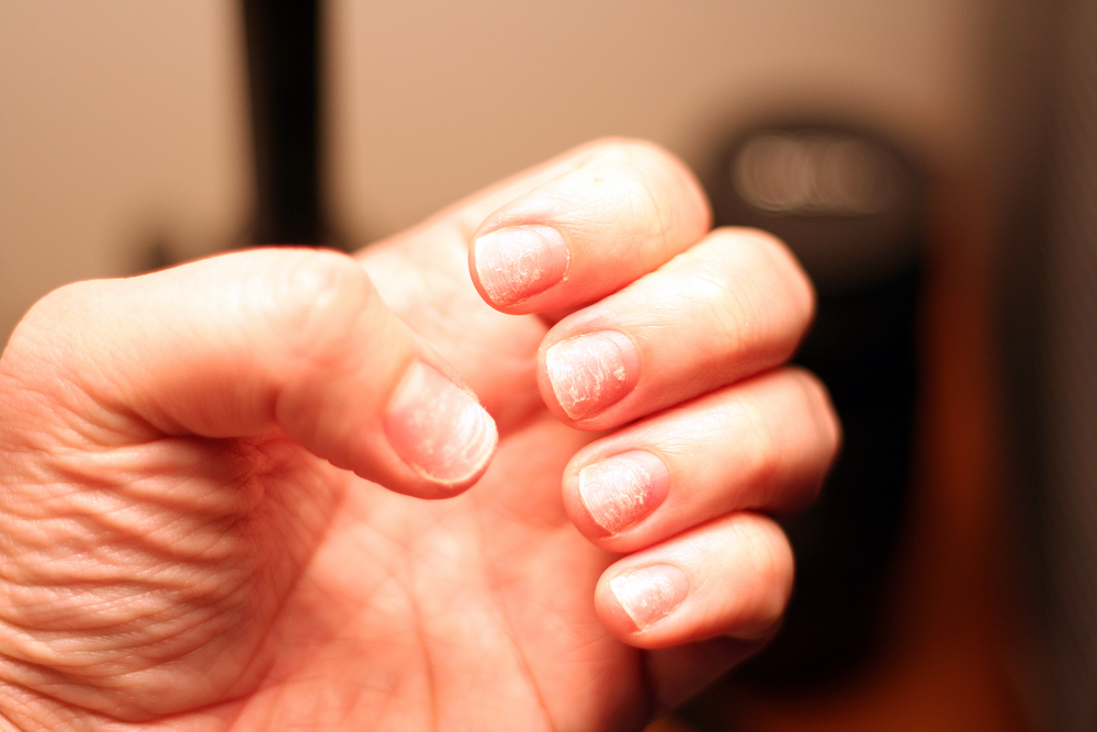 What Makes Your Nails Have Ridges In Them