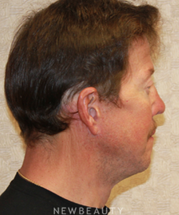 dr-dilip-d-madnani-facelift-necklift-eyelift-b