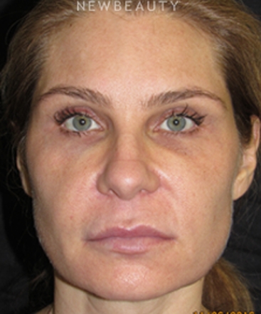 dr-joseph-grzeskiewicz-macs-facelift-b
