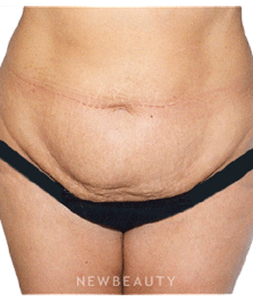 dr-david-rapaport-liposuction-b