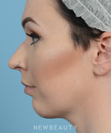 dr-jeffrey-wise-rhinoplasty-b