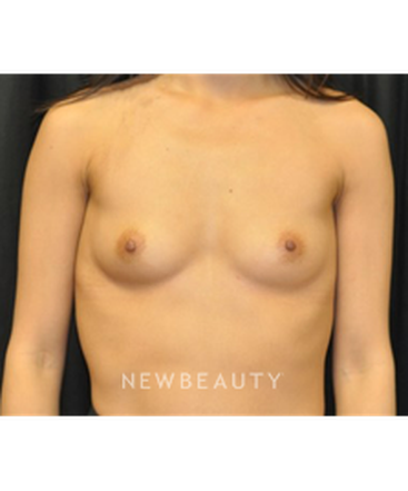 dr-andrew-smith-breast-augmentation-b