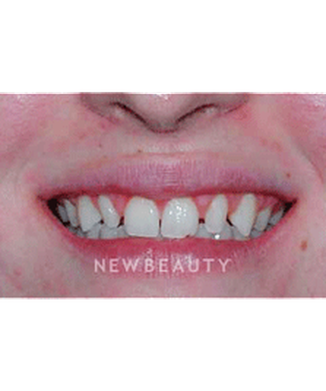 dr-guy-lewis-veneers-b