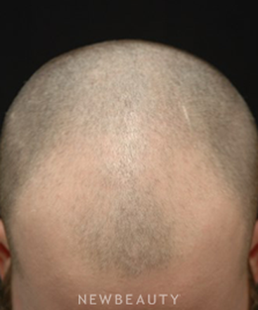 dr-jeffrey-b-wise-hair-transplant-b