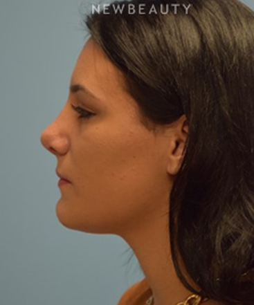 dr-jeffrey-b-wise-rhinoplasty-b