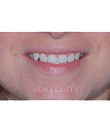 dr-guy-lewis-veneers-b