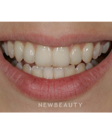 dr-laurence-rifkin-veneers-b