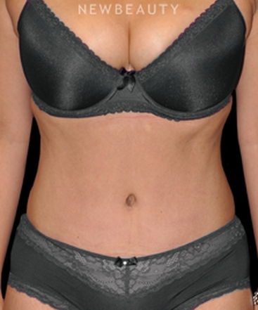 dr-bryan-w-gawley-full-tummy-tuck-b