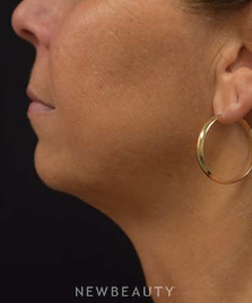 dr-jeffrey-b-wise-ultherapy-juvederm-b