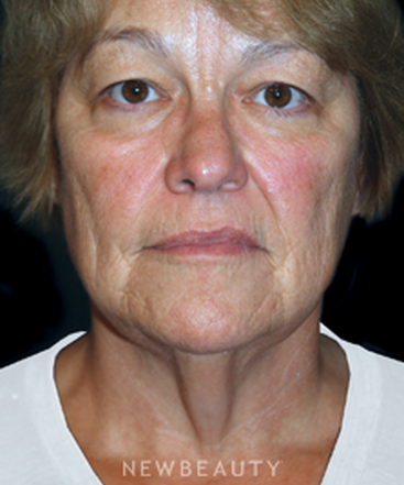 dr-brent-smith-eyelift-facelift-b