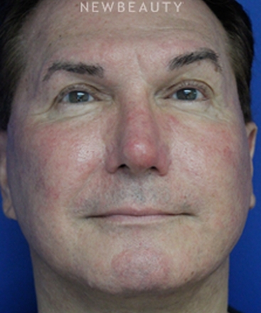 dr-joseph-russo-natural-looking-results-face-ebg-b