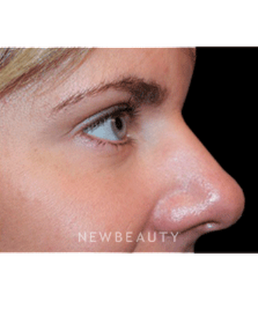 dr-marina-peredo-botox-b